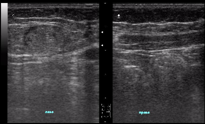 УЗИ мягких тканей.png