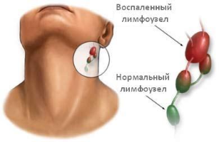 УЗИ лимфатических узлов.png